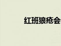 紅班狼瘡會(huì)遺傳嗎（紅班狼瘡）