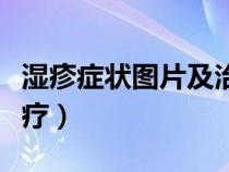 濕疹癥狀圖片及治療方法（濕疹癥狀圖片及治療）